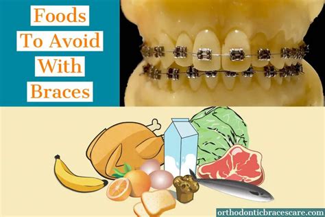 10 Things to Avoid When Wearing Braces